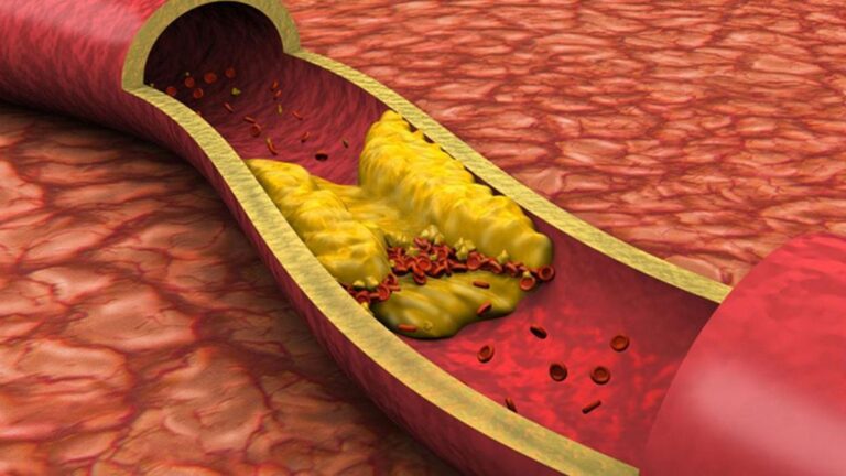 Kolesterol nedir? Kolesterol belirtileri nelerdir?